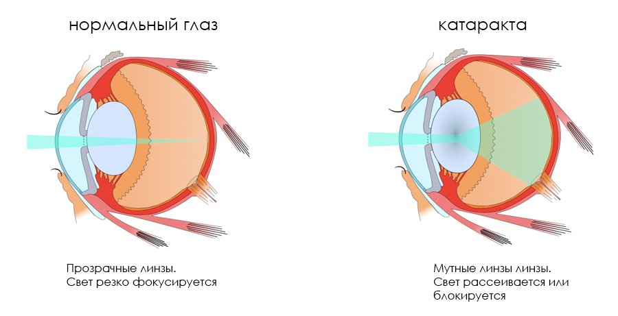 катаракта глаза схема